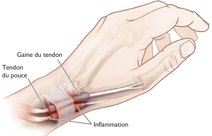 Tendinites & traumatismes