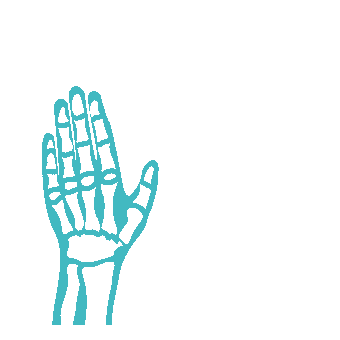 Syndrome d'Elhers Danlos